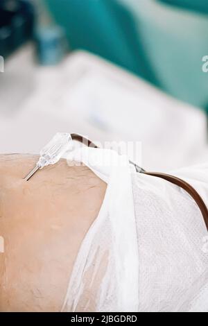 Catetere in primo piano in vena. Giornata internazionale della donazione di sangue. Il donatore dona sangue per salvare la vita. Trasfusione di sangue in laboratorio medico. Foto Stock