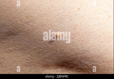 Foto closeup di tag cutaneo o talpa cutanea su un corpo umano. Esame dermatologico Foto Stock