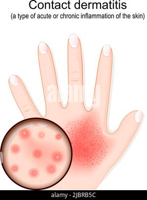 Dermatite da contatto. Eczema atopico. Primo piano di rash a portata di mano. Pelle umana con dermatite. Penetrazione di allergeni. Illustrazione vettoriale Illustrazione Vettoriale