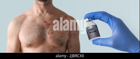 Vaccino scimmipox in mano del medico con petto maschile affetto da eruzione cutanea vescicolante a causa della scimmipox in background. Foto Stock