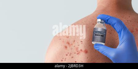 Vaccino scimmipox in mano del medico con la schiena maschile affetta da eruzione cutanea vescicolosa a causa della scimmipox in background. Foto Stock