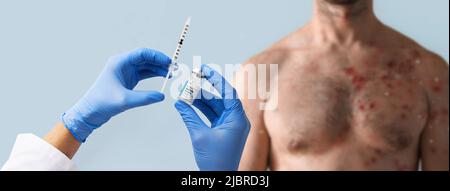 Vaccino scimmipox in mano del medico con petto maschile affetto da eruzione cutanea vescicolante a causa della scimmipox in background. Foto Stock