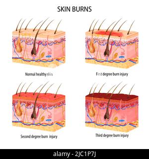 Insieme realistico di normale e tre gradi di ustioni struttura della pelle isolato su sfondo bianco illustrazione vettoriale Illustrazione Vettoriale