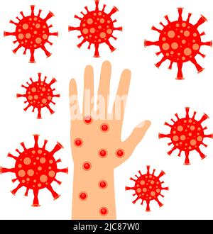 Virus Monkeypox, mano nelle ulcere del vaiolo. Scimmie vaiolo. Illustrazione vettoriale Illustrazione Vettoriale