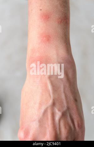 Reazione allergica a punture di insetto con macchie di gonfiore rotonde sul braccio di una donna Foto Stock