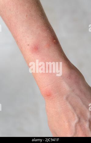 Reazione allergica a punture di insetto con macchie di gonfiore rotonde sul braccio di una donna Foto Stock