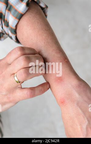 Reazione allergica a punture di insetto con macchie di gonfiore rotonde sul braccio di una donna Foto Stock