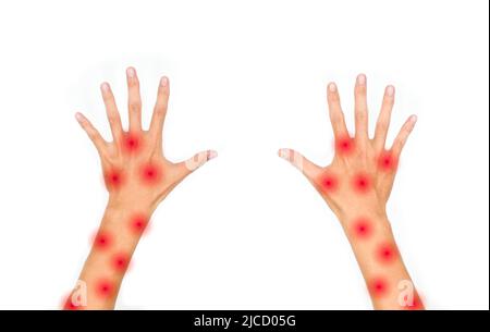 La pelle di Monkeypox si erassa su entrambe le braccia del giovane asiatico. Isolato su bianco. Foto Stock