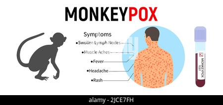 Banner con una sagoma di una scimmia, una provetta per il sangue, con un testo dei sintomi della scimmia e un corpo umano con un'eruzione cutanea. Concetto di virale Illustrazione Vettoriale