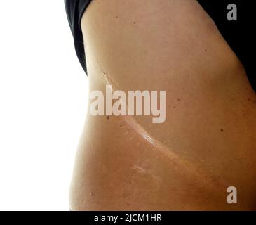 Cicatrice chirurgica sul lato destro a causa di un trapianto di rene Foto Stock