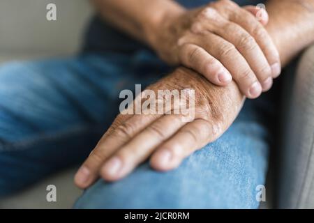 Uomo anziano affetto da psoriasi, primo piano sulle mani Foto Stock