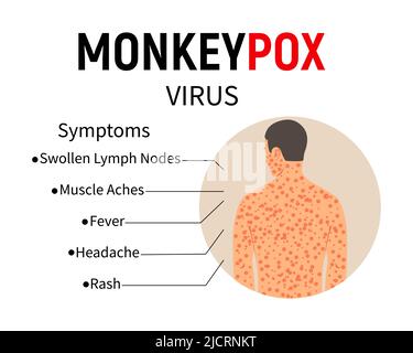 Sintomi della scimmietta. Infografica sulla malattia. Testo e uomo con rash e ulcere sul corpo. Sintomi della malattia - gonfiore dei linfonodi, dolore muscolare Illustrazione Vettoriale