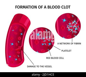 Infografica educativa sulla coagulazione del trombo delle cellule del sangue grafico colorato che illustra il processo di formazione del coagulo Illustrazione Vettoriale