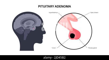 Cancro dell'adenoma ipofisario, illustrazione Foto Stock