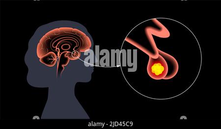 Cancro dell'adenoma ipofisario, illustrazione Foto Stock