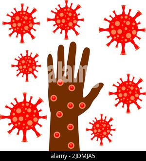 Virus Monkeypox, mano nelle ulcere del vaiolo. Scimmie vaiolo. Illustrazione vettoriale Illustrazione Vettoriale