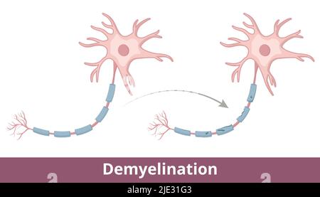 Processo di demielinizzazione. La copertura protettiva (guaina di mielina) che circonda le fibre nervose è danneggiata a causa di malattie come la sclerosi multipla Illustrazione Vettoriale