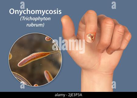 Illustrazione di un'infezione fungina delle unghie che mostra la mano umana con onicomicosi e vista ravvicinata dei funghi trichopyton rubrum, uno degli agenti causativi delle infezioni delle unghie. Foto Stock