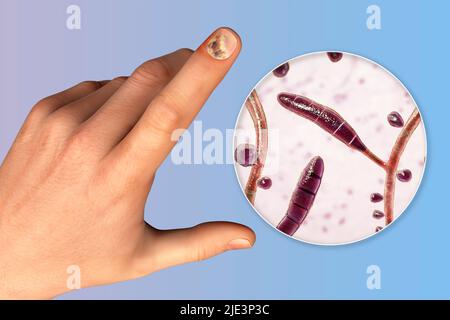 Illustrazione di un'infezione fungina delle unghie che mostra la mano umana con onicomicosi e vista ravvicinata dei funghi trichopyton rubrum, uno degli agenti causativi delle infezioni delle unghie. Foto Stock