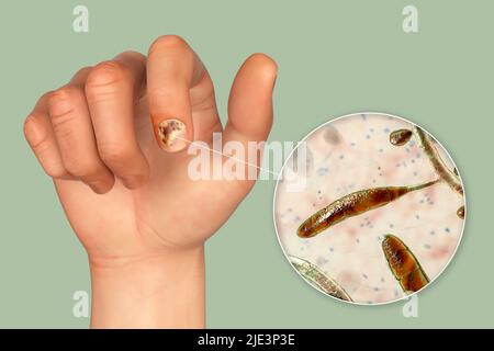 Illustrazione di un'infezione fungina delle unghie che mostra la mano umana con onicomicosi e vista ravvicinata dei funghi trichopyton rubrum, uno degli agenti causativi delle infezioni delle unghie. Foto Stock