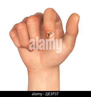 Infezione unghie fungine, illustrazione. Nota come onicomicosi, o tinea unguium, questa condizione può essere causata da vari funghi che scoloriscono le unghie. Il trattamento è con creme o farmaci antifungini. Foto Stock
