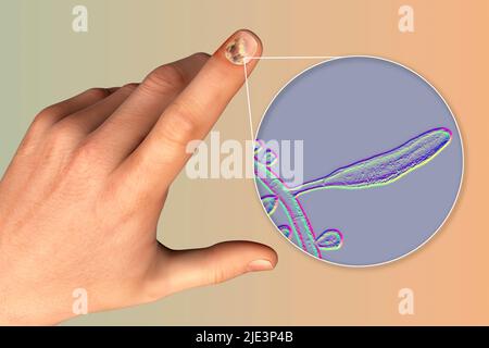 Illustrazione di un'infezione fungina delle unghie che mostra la mano umana con onicomicosi e vista ravvicinata dei funghi trichopyton rubrum, uno degli agenti causativi delle infezioni delle unghie. Foto Stock