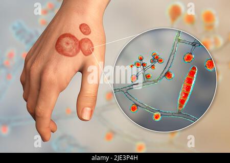 Infezione fungina sulla mano di un uomo, illustrazione. Noto come infezione da trenino, o tinea manuum. Può essere causato da vari funghi, tra cui mentagrofiti di Trichophyton. Provoca prurito grave. La malattia è altamente contagiosa e può essere diffusa per contatto diretto o per contatto con materiale contaminato. Il trattamento è con farmaci antifungini. Foto Stock