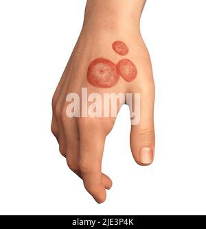 Infezione fungina sulla mano di un uomo, illustrazione. Noto come infezione da trenino, o tinea manuum. Può essere causato da vari funghi, tra cui Microsporum e Trichophyton. Provoca prurito grave. La malattia è altamente contagiosa e può essere diffusa per contatto diretto o per contatto con materiale contaminato. Il trattamento è con farmaci antifungini. Foto Stock