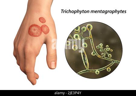 Infezione fungina sulla mano di un uomo, illustrazione. Noto come infezione da trenino, o tinea manuum. Può essere causato da vari funghi, tra cui mentagrofiti di Trichophyton. Provoca prurito grave. La malattia è altamente contagiosa e può essere diffusa per contatto diretto o per contatto con materiale contaminato. Il trattamento è con farmaci antifungini. Foto Stock