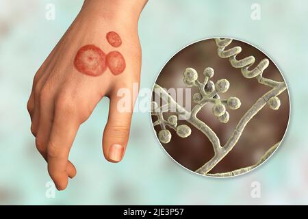 Infezione fungina sulla mano di un uomo, illustrazione. Noto come infezione da trenino, o tinea manuum. Può essere causato da vari funghi, tra cui mentagrofiti di Trichophyton. Provoca prurito grave. La malattia è altamente contagiosa e può essere diffusa per contatto diretto o per contatto con materiale contaminato. Il trattamento è con farmaci antifungini. Foto Stock