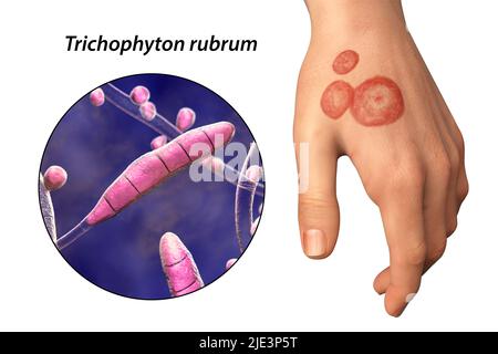 Infezione fungina sulla mano di un uomo, illustrazione. Noto come infezione da trenino, o tinea manuum. Può essere causato da vari funghi, compreso il rubrum di Trichophyton. Provoca prurito grave. La malattia è altamente contagiosa e può essere diffusa per contatto diretto o per contatto con materiale contaminato. Il trattamento è con farmaci antifungini. Foto Stock