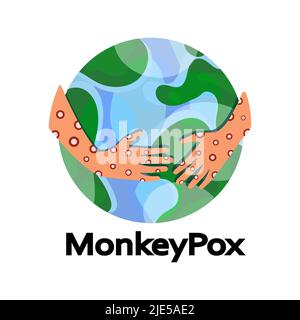 Virus Monkeypox. Eruzione sul corpo. Virus della varicella scimmia sintomi sulla mano rash infezione. Pandemia globale nel mondo. Illustrazione vettoriale Illustrazione Vettoriale