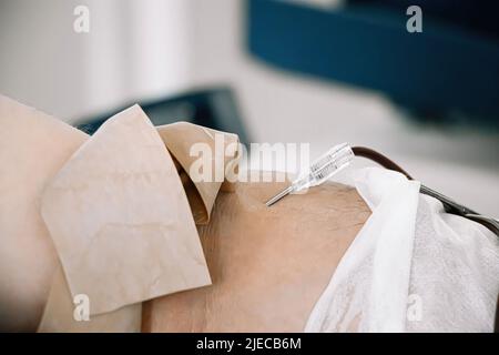 Catetere in primo piano in vena. Giornata internazionale della donazione di sangue. Il donatore dona sangue per salvare la vita. Trasfusione di sangue in laboratorio medico. Foto Stock