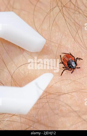 Zeckenzange und Hirschzecke, auch Rehzecke oder Schwarzbeiniger Holzbock (Ixodes scapularis say), auf menschlicher Haut, Zange zum entfernen der Zecke Foto Stock