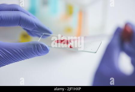 Primo piano di un ricercatore di laboratorio non riconoscibile in guanti di gomma che esaminano il campione di sangue sul vetrino del microscopio Foto Stock