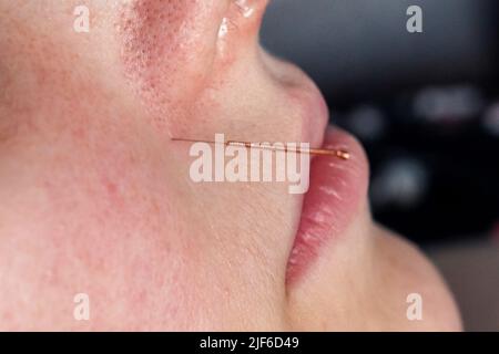 Un ritratto in primo piano di un piccolo ago di agopuntura che si attacca nel viso di una persona accanto al naso, per alleviare lo stress, guarire il dolore o un altro condimento medico Foto Stock