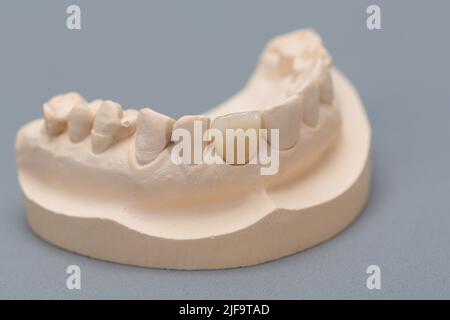 primo piano della denizione artiale pronta per l'uso sul banco da lavoro da laboratorio odontoiatrico Foto Stock