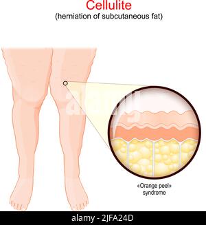 Cellulite. Femmine gambe con adiposis edematosa. Primo piano di una pelle umana con sindrome da buccia d'arancia. Herniation di grasso sottocutaneo. Vettore Illustrazione Vettoriale