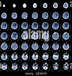 Scansione RM del cervello. Scansione di imaging a risonanza magnetica. Medicina, scienza e istruzione CT background Foto Stock