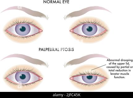 L'illustrazione medica mostra il confronto tra un occhio normale e uno affetto da ptosi palpebrale. Illustrazione Vettoriale