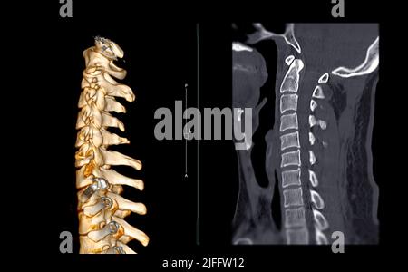 SCANSIONE TC della vista coronale e sagittale della colonna cervicale ( colonna C ) nel caso di trauma del paziente . Concetto di tecnologia medica. Foto Stock