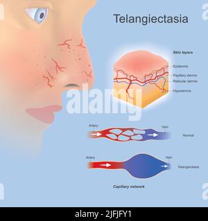 Telangiectasia. Problema piccoli vasi sanguigni allargati o formati situati vicino a strati di superficie della pelle e si può vedere chiaramente. Illustrazione Vettoriale