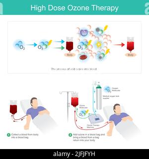 Terapia con ozono ad alta dose. Questo processo aggiungere ozono in un sacchetto di sangue e portare un sangue da un ritorno sacchetto nel vostro corpo. Illustrazione Vettoriale