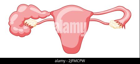 Hydrosalpinx sistema riproduttivo femminile bloccato tubo di Falloppio utero con testo descrittivo. Anatomia umana organi interni vettore immagine medica icona di stile piatto isolato su sfondo bianco Illustrazione Vettoriale