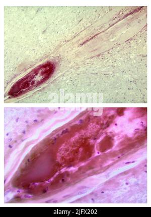 Fotomicrografia del midollo spinale lombare raffigurante un infarto do a Polio di tipo III che circonda l'arteria spinale anteriore. Quando i neuroni spinali stessi muoiono, la degenerazione walleriana avviene con conseguente debolezza muscolare di quei muscoli una volta innervati dai neuroni ormai morti (denervati). Il grado di paralisi è direttamente correlato al numero di neuroni deceduti. Versioni ottimizzate e migliorate delle immagini prodotte dai Centri statunitensi per il controllo e la prevenzione delle malattie / credito CDC /Dr.Karp Foto Stock