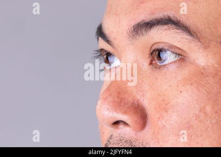 Macro pelle viso di uomo asiatico per mostrare molti problemi di pelle. Uomo cura della pelle concetto su sfondo grigio spazio Foto Stock