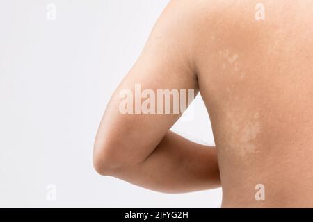 Concetto sanitario : Pityriasis bianco Macro o Tinea Versicolor sulla pelle posteriore. Utilizzato per il concetto di cura della pelle Foto Stock