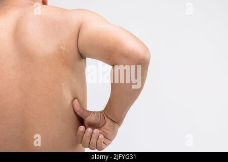 Concetto sanitario : Pityriasis bianco Macro o Tinea Versicolor sulla pelle posteriore. Utilizzato per il concetto di cura della pelle Foto Stock