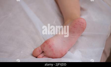 Piede bambino con eritema pruriginoso rosso primo piano Foto Stock