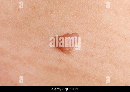 papilloma cancro sulla pelle, verruca primo piano. Foto Stock